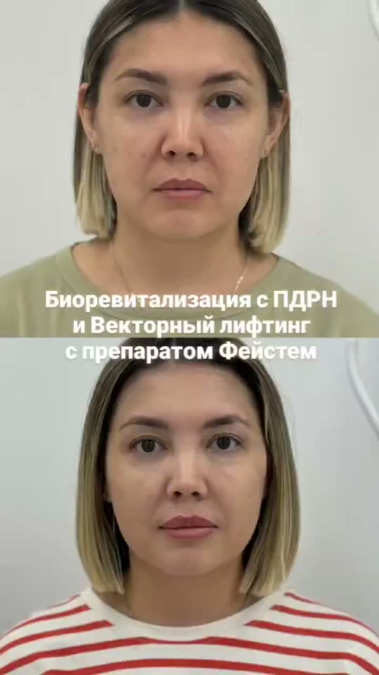Биоревитализация ПДРН / Векторный лифтинг Facetem — результат до и после