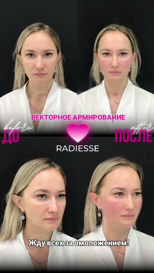 Векторное армирование Radiesse — результат до и после