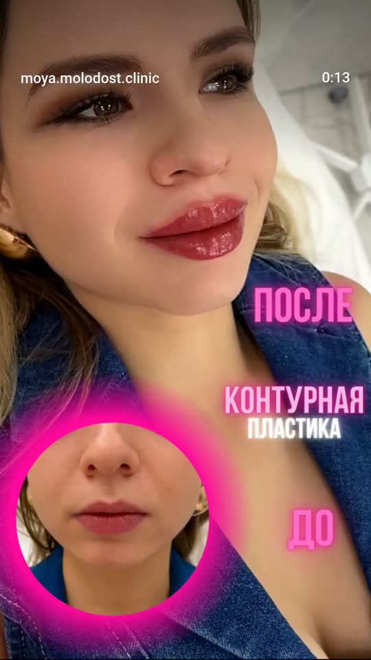 Контурная пластика — результат до и после