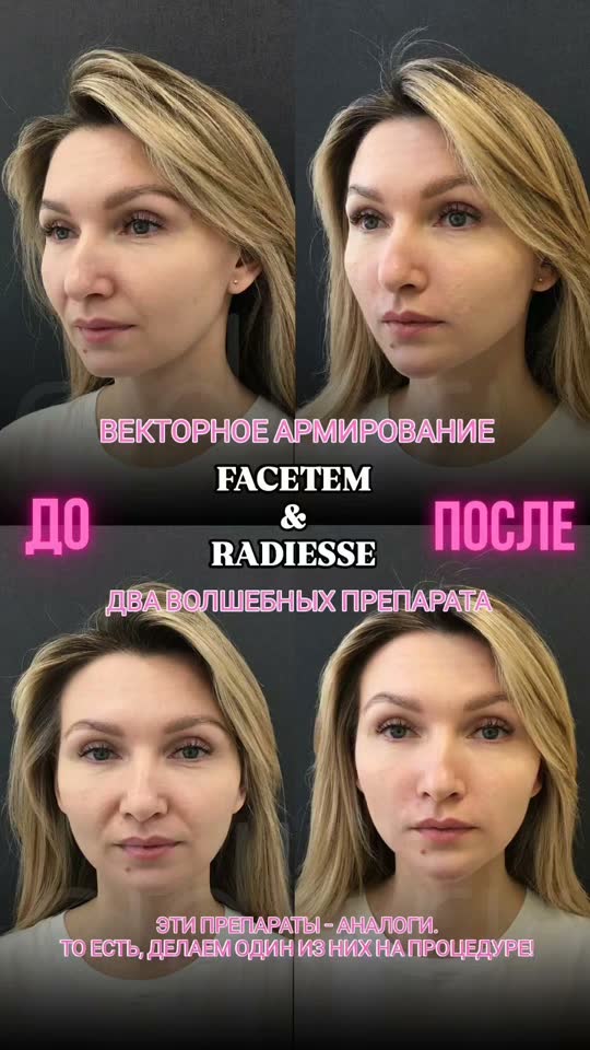 Векторное армирование (Facetem + Radiesse) — результат до и после