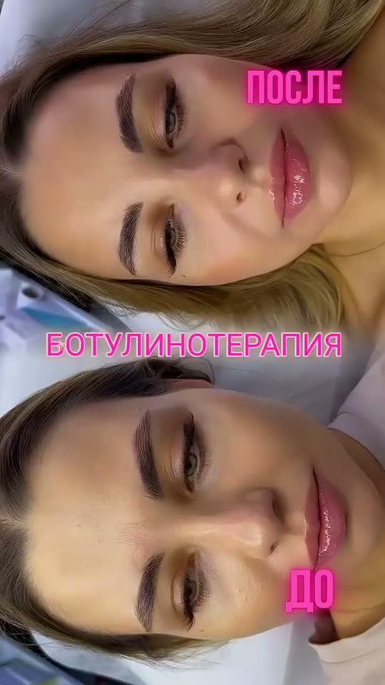 Ботулинотерапия - Лоб, межбровка и глаза — результат до и после