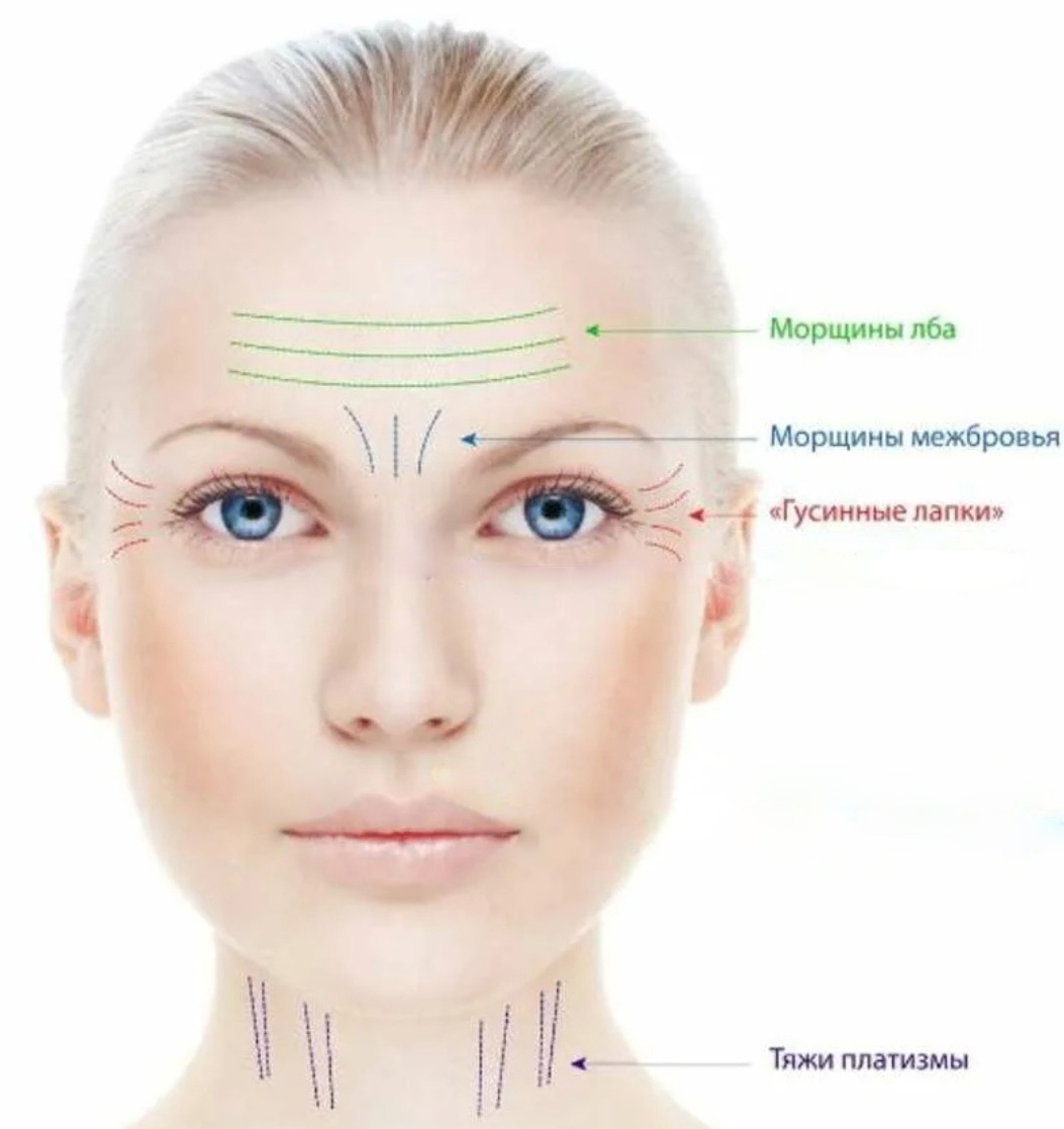Botox/Диспорт/Xeomin/Релатокс Ботулинотерапия верхней трети лица + тяжи платизмы «под ключ» + крольчачий носик в подарок — Ботулинотерапия в Казани