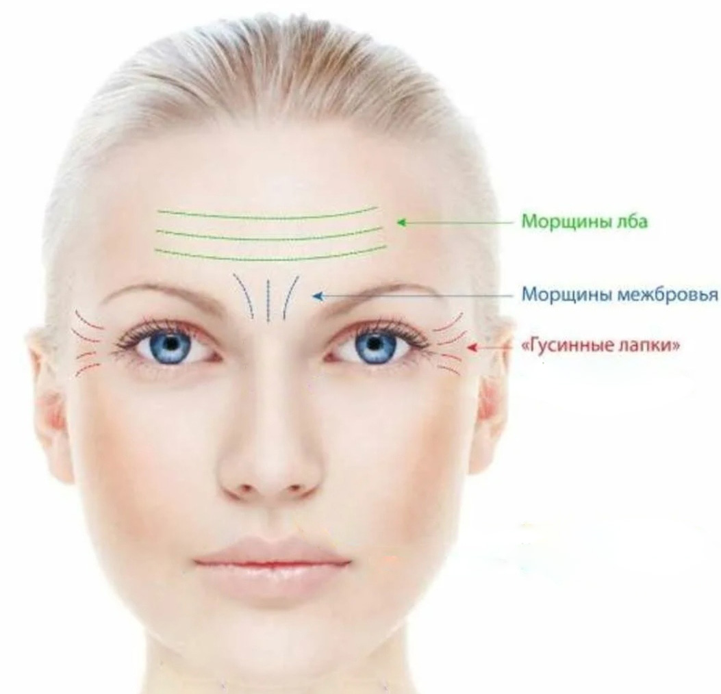 Botox/Диспорт/Xeomin/Релатокс Верхняя треть лица (лоб, межбровье, гусиные лапки) + тяжи платизмы "под ключ"