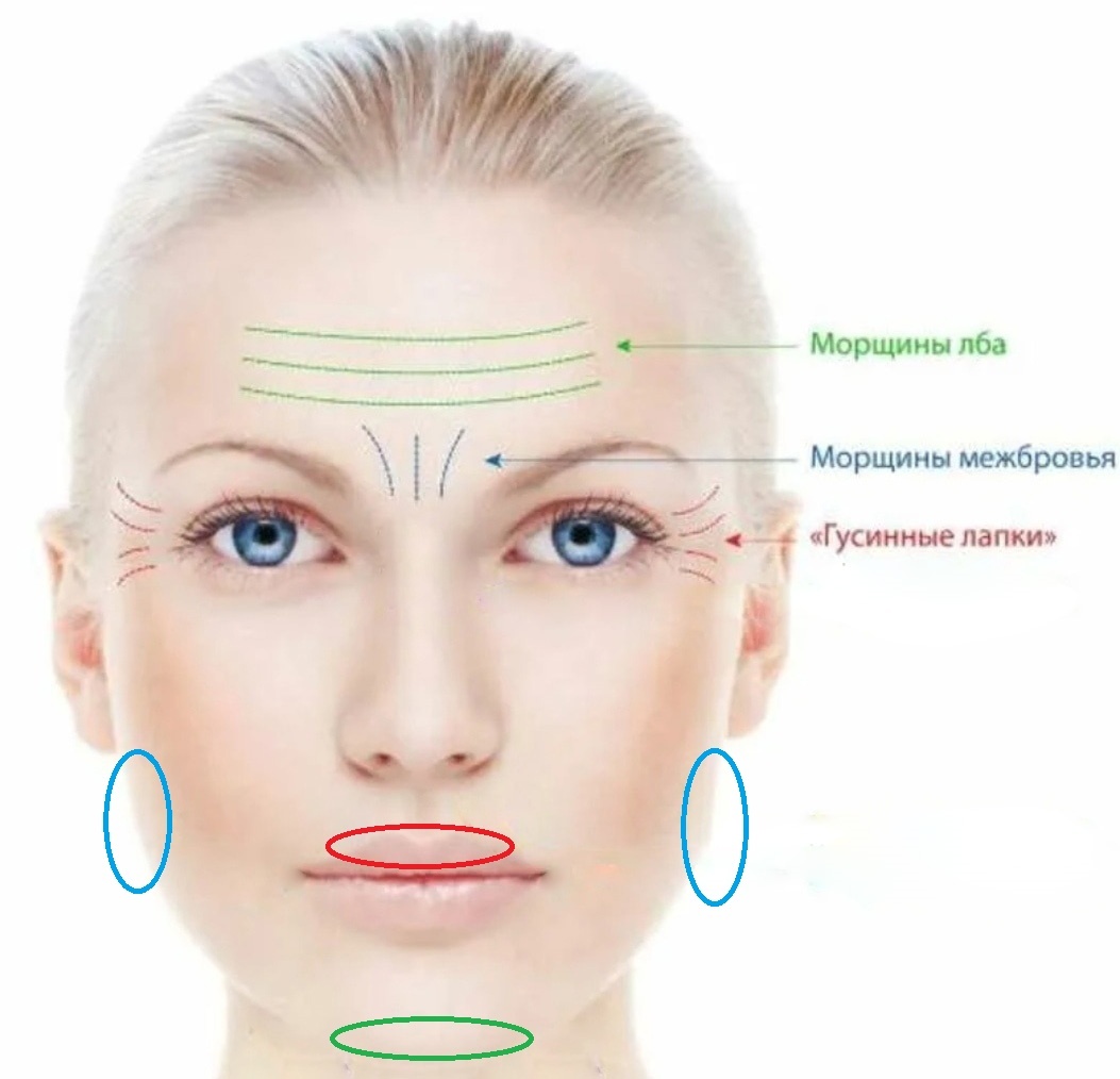 Botox/Диспорт/Xeomin/Релатокс Губы, подбородок, скулы - 1.1 мл. + Ботулинотерапия 3-зоны (верхняя треть)